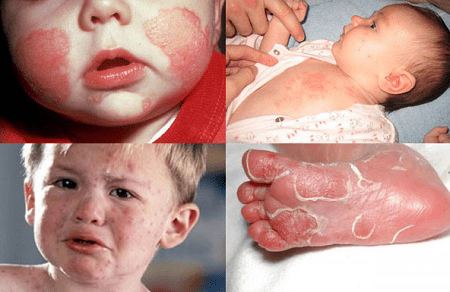 Triệu chứng giang mai bẩm sinh ở trẻ