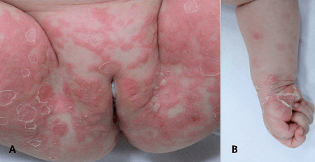 Con đường dẫn đến trẻ nhỏ sinh ra bị bệnh giang mai