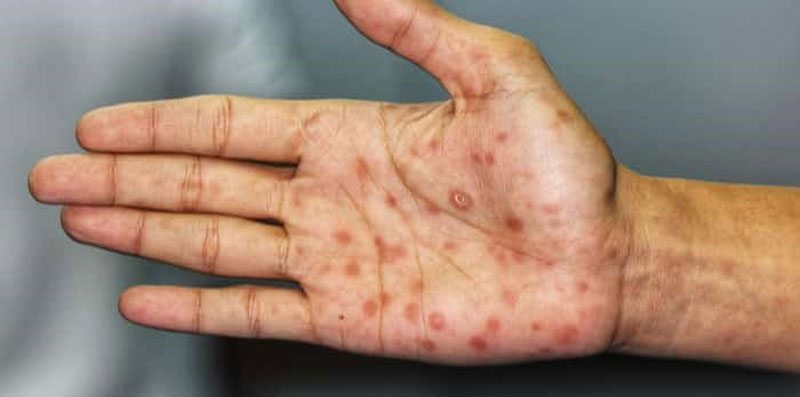 Giang mai điều trị bao lâu, thời gian điều trị phụ thuộc vào những yếu tố nào?