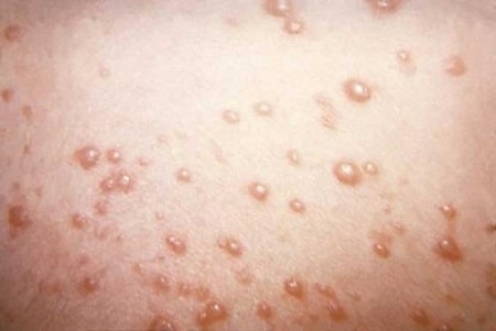 Tìm hiểu khái niệm về giang mai giai đoạn 1