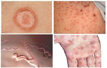 Nhận biết các triệu chứng giang mai giai đoạn 2