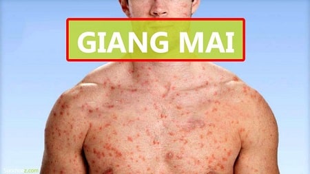 Giai đoạn đào ban giang mai có nguy hiểm không? 