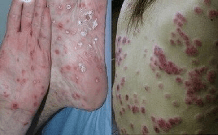 Dấu hiệu nhận biết giang mai giai đoạn cuối