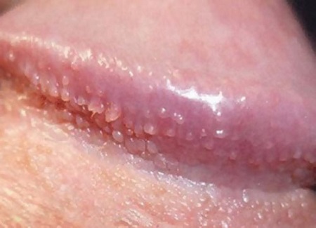 Nổi mụn nhỏ trắng ở rãnh bao quy đầu là bệnh gì?