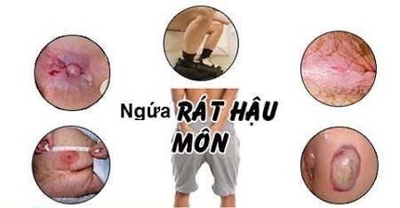 Hậu môn bị ngứa nguyên nhân do đâu?