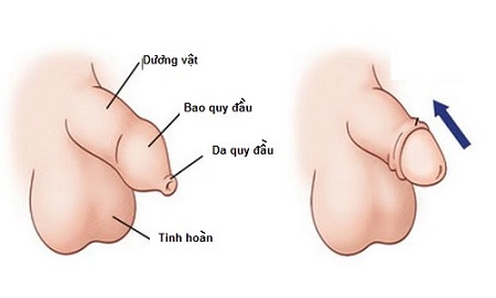 Hẹp bao quy đầu là gì ?