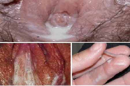Nhận biết các dấu hiệu bệnh lậu ở nữ giới