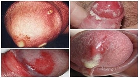Dấu hiệu bệnh lậu ở nam cần biết
