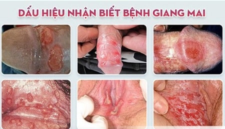 Hình ảnh bệnh giang mai qua các giai đoạn