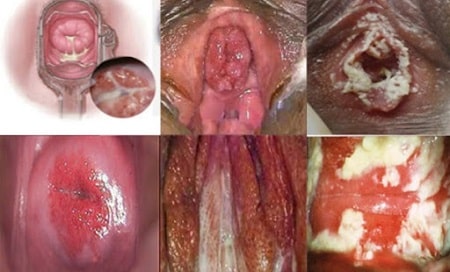 Hình ảnh dấu hiệu bệnh lậu ở nữ giới