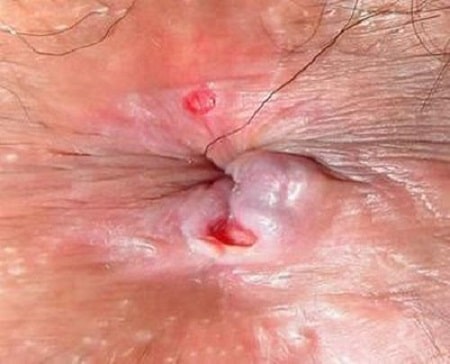 Hình ảnh bệnh lậu tại hậu môn