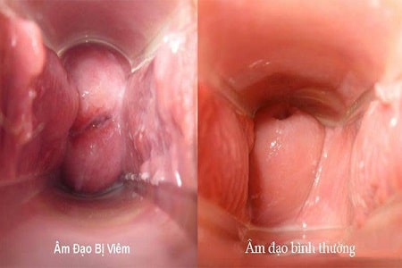 Hình ảnh bệnh viêm nhiễm phụ khoa chị em dễ mắc phải