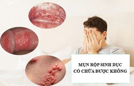 Phương pháp điều trị dứt điểm mụn rộp sinh dục