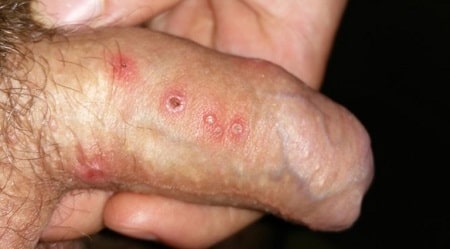Triệu chứng và hình ảnh mụn rộp sinh dục nam giới 