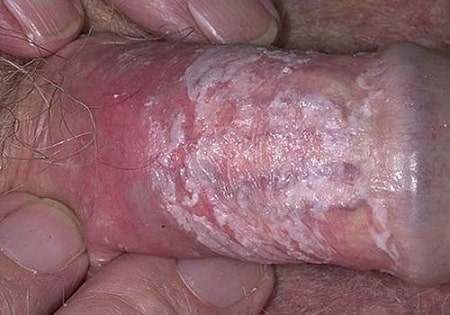 Tìm hiểu về loại nấm Candida ở bao quy đầu