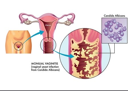 Hình ảnh nấm candida soi tươi gây ra những triệu chứng gì?