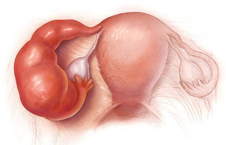  Hình ảnh ống dẫn trứng bị ứ nước
