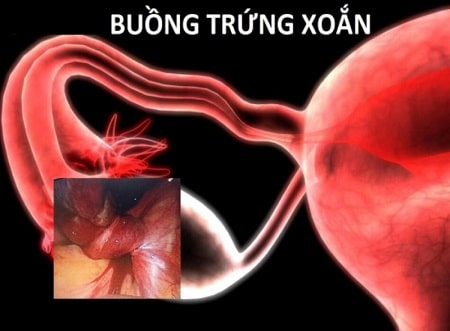 Hình ảnh ống dẫn trứng bị xoắn