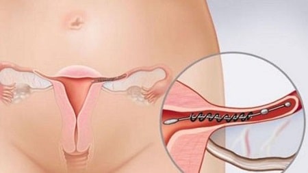 Những phương pháp điều trị viêm ống dẫn trứng hiện nay