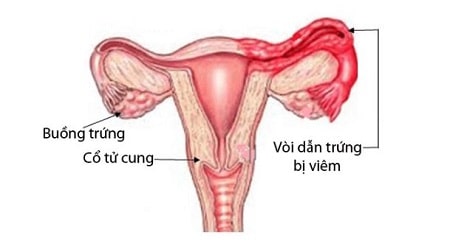 Cụ thể hình ảnh ống dẫn trứng bị viêm liệu bạn đã biết