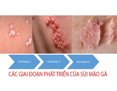 Trước khi đốt sùi mào gà