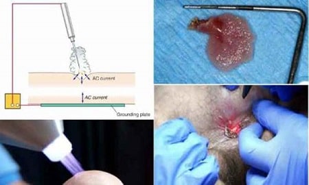 Đốt sùi mào gà là gì ? Có nên đốt sùi mào gà không?