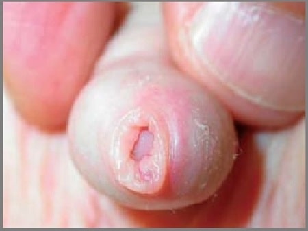 Hình ảnh viêm bao quy đầu ở trẻ nhỏ do hẹp bao quy đầu