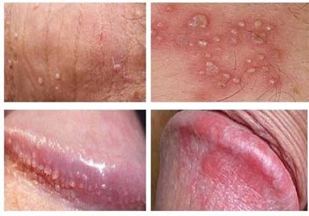 Viêm bao quy đầu là bệnh gì ?