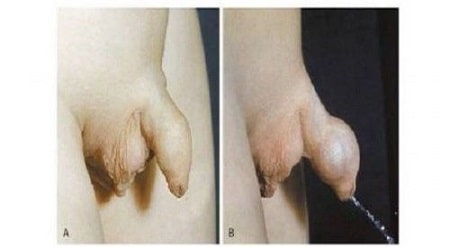 Hình ảnh viêm nhiễm bao quy đầu ở trẻ
