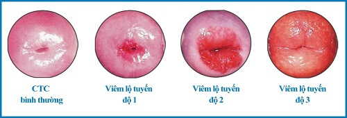 Hình ảnh viêm cổ tử cung lộ tuyến qua các cấp độ