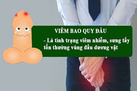 Viêm bao quy đầu là bệnh gì ?
