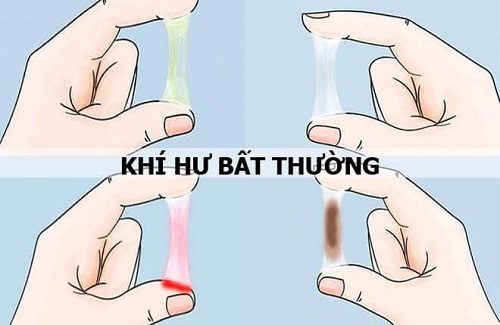 Khí hư bất thường