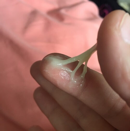Khí hư màu xanh như nước mũi 