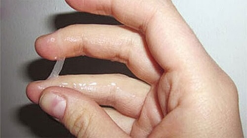 Khí hư ra nhiều bất thường