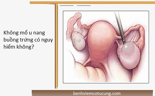 Không mổ u nang buồng trứng có nguy hiểm không?