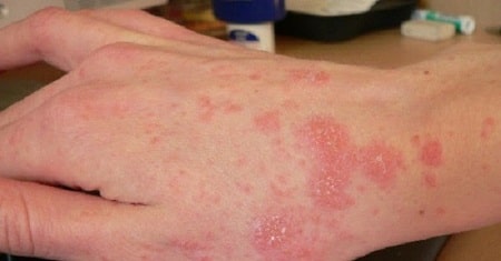 Chữa nấm candida ở da