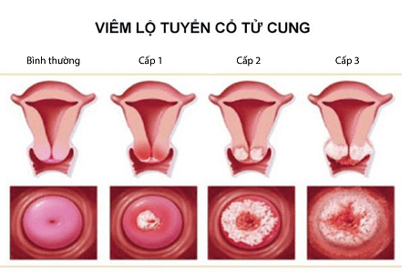 Đốt viêm lộ tuyến cổ tử cung có nghĩa là gì?