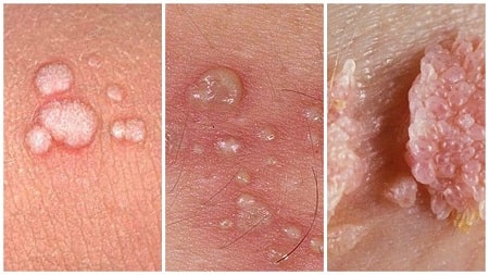 Tìm hiểu về bệnh sùi mào gà