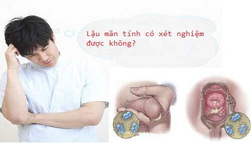 Bệnh lậu mãn tính hoàn toàn có thể xét nghiệm được nếu người bệnh tuân thủ theo sự hướng dẫn của bác sĩ chuyên khoa
