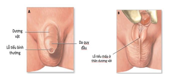 Lệch lỗ tiểu