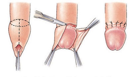 Tìm hiểu những lợi ích của việc cắt bao quy đầu ở nam giới