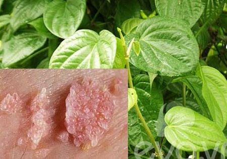 Mẹo chữa sùi mào gà tại nhà bằng lá trầu không