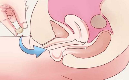 Cách đặt thuốc chữa viêm lộ tuyến cổ tử cung