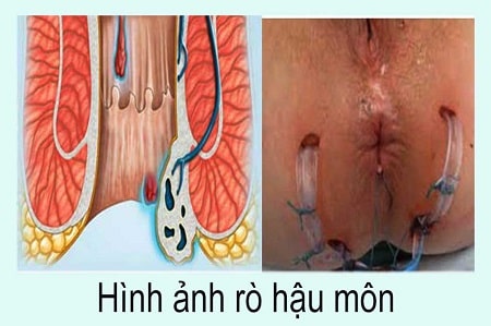Dấu hiệu nhận biết bệnh rò hậu môn từ sớm