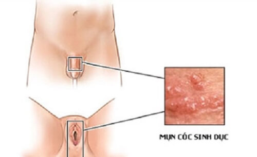Mụn cóc bộ phận sinh dục nam, nữ