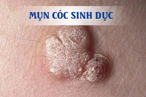Mụn cóc sinh dục