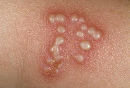 Nổi mụn ngứa ở cô bé do mụn rộp sinh dục