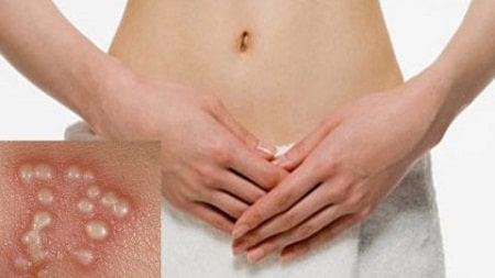 Mụn rộp sinh dục bị vỡ phải xử lý thế nào?