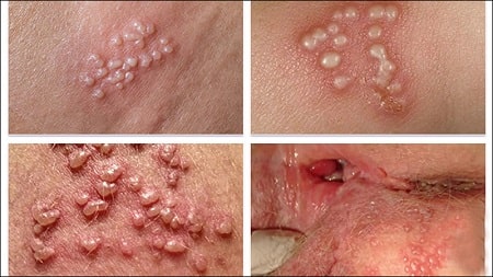 Phòng ngừa mụn rộp sinh dục bằng cách nào ?