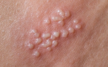 Mụn rộp sinh dục là gì ?